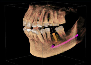 東中野 原歯科医院 ではCTを利用してインプラント治療のシミュレーションを行ってから施術を行うことが可能です